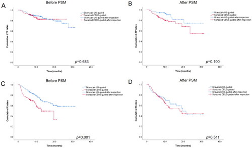 Figure 2. Kaplan–Meier curves for patients who underwent grayscale US-guided or Sonazoid CEUS-guided ablation before and after propensity score matching (PSM). (A) local tumor progression-free survival (LTPFS) curve before PSM. (B) LTPFS curve after PSM. (C) intrahepatic recurrence-free survival curve before PSM. (D) intrahepatic recurrence-free survival curve after PSM.