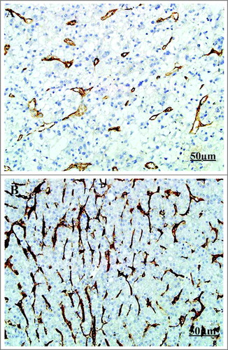 Figure 1 The IHC of CD105 in tumor tissue. (IHC X200. A: Low expression of CD105 in tumor tissue; B: High expression of CD105 in tumor tissue).