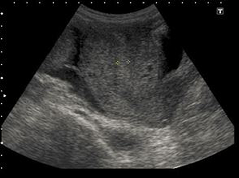 Figure 1 Ultrasound picture shows empty uterus with well apposed endometrium which measures 8.4mm.