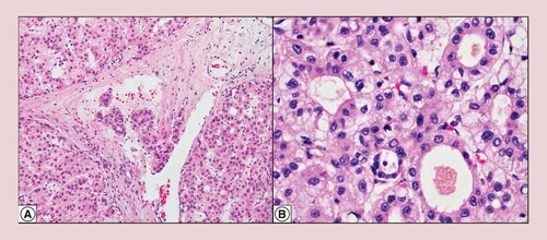 Figure 3. Microscopic venous invasion. There is tumor infiltration into small venous vasculature (hematoxylin and eosin at 200× original magnification) (A). Cirrhotomimetic hepatocellular carcinoma shows predominant pseudoglandular and trabecular histological growth patterns (hematoxylin and eosin at 400× original magnification) (B).