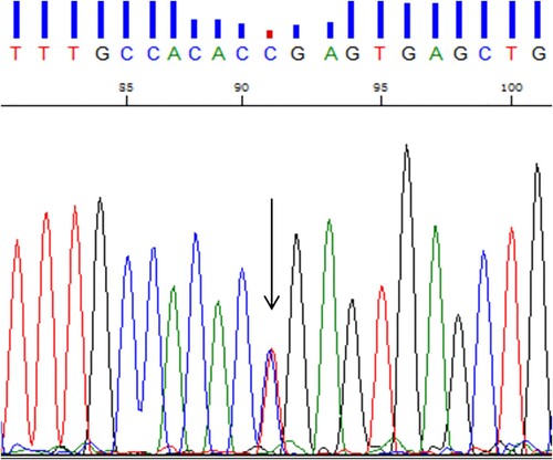 Figure 2. The result of Sanger sequencing. The arrow indicates the CTG > CCG mutation at codon 88 of the HBB gene previously reported as hemoglobin Santa Ana.