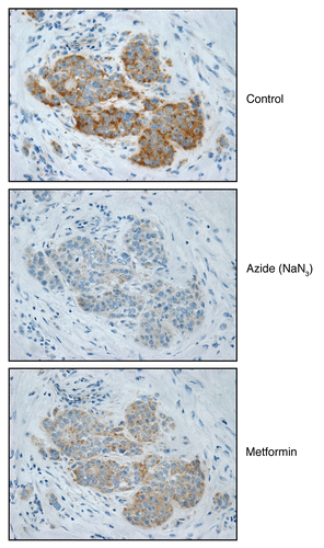 Figure 9 Mitochondrial poisons (azide and metformin) validate the specificity of COX activity staining in human epithelial cancer cells. Serial frozen sections of human breast cancer samples were subjected to COX activity staining (brown color). Slides were then counter-stained with hematoxylin (blue color). Note that sodium azide (1 mM; a Complex IV inhibitor) effectively abolished the COX activity staining, directly demonstrating high-specificity. Treatment with metformin (1 mM; a Complex I inhibitor) also significantly reduced the COX activity staining (Complex IV).