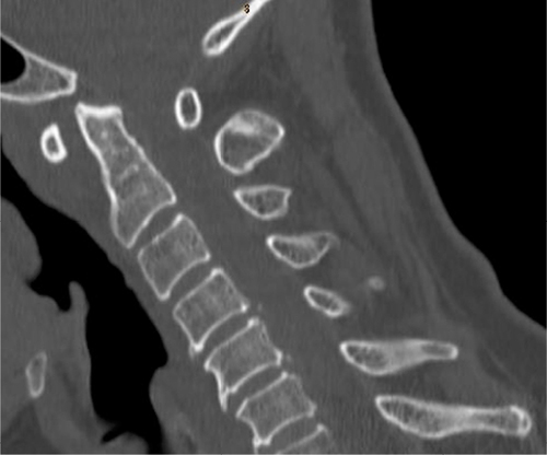 Figure 1 Computed tomography scan showing a sagittal cut of the cervical spine with an increased atlanto-dens interval (6 mm).