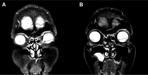 Figure 1 MRI before and after vismodegib and orbital excision.