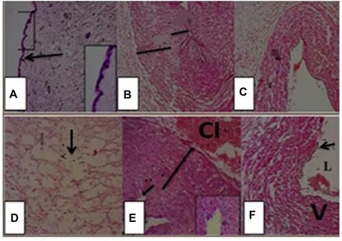 Figure 2 Photomicrographs of umbilical cord sections of control group showing (A) Wharton’s jelly, fibroblast cells  and enclosed by amniotic membrane (arrow). The inset is higher magnification of the amniotic membrane. (B) Showing part of umbilical artery with lumen (L), intima (short black line) and thick media (long black line) with no adventitia, surrounded by Wharton’s jelly (lightly stained). (C) Showing the umbilical vein wide lumen, thin intima and thin media, and surrounded by Wharton’s jelly. Umbilical cord sections of diabetic group showing (D) Wharton’s jelly, notice honey combs (↓). (E) Showing part of umbilical artery (A) with narrow lumen (L), intima (short black line) and thick media with cellular debris (long black line), with extra cellular infiltration (CI), with focal erosion of endothelial lining.  (F) Showing the wall of umbilical vein (V) with thinner wall and wider lumen (L), with cellular debris in media.
