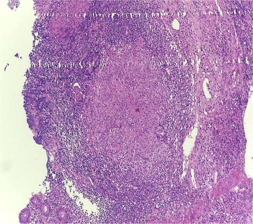 Figure 2 The histology showed ulceration and granulation tissue formation, foci of necrotizing granulomatous inflammation in lamina propria with adjacent mild crypt regenerative changes (H&E, original magnification, 10×).