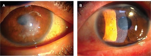 Figure 1 Preoperative slit-lamp photographs.