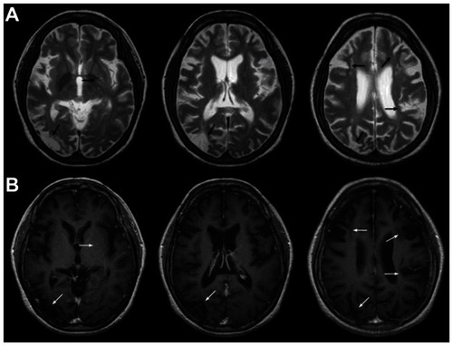 Figure 1 Case 1: brain magnetic resonance imaging (MRI) showed old infarction and encephalomalacia lesions in the left lentiform nucleus, right temporal, occipital, and bilateral frontal and parietal lobes, with hyperintensity on T2-weighted imaging (A) and hypointensity without enhancement on postenhanced T1-weighted imaging (B).