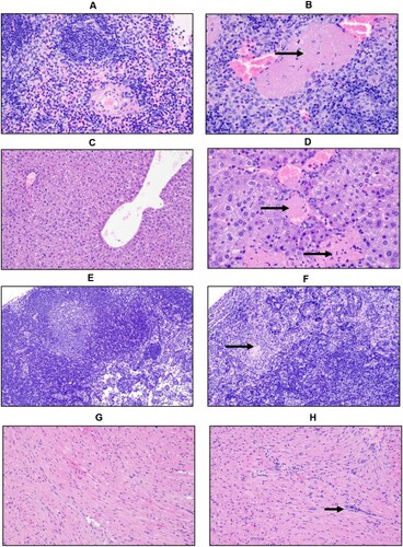 Figure 4. Histopathologic changes in IFNAR-/- mice infected with AHFV. Groups of six mice were infected IP with 1000 LD50 (400 TCID50) and euthanized at 2 dpi and 4 dpi for organ harvest. (A and B) H&E stain of spleens from mice at 4 dpi (A, Mock 400×; B, AHFV infection 400×). We observed a reduction in the white pulp and expansion of the red pulp in infected animals indicating lymphoid depletion. There was neutrophil infiltration and vascular occlusion by a fibrin thrombus (arrow). (C and D) H&E stain of livers from mice at 4 dpi (C, Mock 200×; D, AHFV infection 400×). Hepatocytes were swollen and contained lipid micro-vesicles. There was an increase in sinusoidal inflammatory cells and, along the bottom of the frame, a focus of necrosis (bottom arrow). Fibrin thrombi occluded adjacent vessels (top arrow). (E and F) H&E stain of cervical lymph nodes from mice at 4 dpi (E, Mock 200×; F, AHFV infection 200×). Lymph nodes from infected animals exhibited tremendous lymphocyte apoptosis, infiltrating neutrophils and occasional fibrin thrombi (arrow). (G and H) H&E stain of heart from mice at 4 dpi (E, Mock 200×; F, AHFV infection 200×). Increased cellularity due to interstitial inflammation was seen in infected animals (arrows).