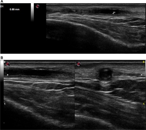 Figure 1 (A) Before treatment: left temporal artery ultrasonography features before steroid therapy showed a hypoechogenic halo of the temporal artery >0.5 mm in thickness. (B) Before treatment: left temporal artery ultrasonography features before steroid therapy showed a hypoechogenic halo of the temporal artery in longitudinal (left) and transverse (right) view (B-mode ultrasound).