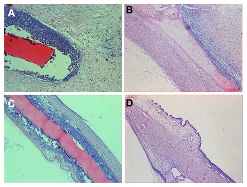 Figure 4 (A–D) Pathological slides at day 28 after operation. (A) 5-Fluorouracil group: chitosan membrane well tolerated without degradation, inflammatory cells filtrated into the gap between membrane and surrounding sclera tissue (× 5). (B) Mitomycin C group: chitosan membrane partially degraded, few inflammatory cells filtrated (× 5). (C) Blank/placebo group: no degradation of chitosan membrane, surrounded by inflammatory cells filtrated into the gap between membrane and surrounding sclera tissue (× 5). (D) Control group: sclera and conjunctiva recovered to normal (× 5).