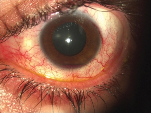 Figure 2 Patient with a small hyphema.