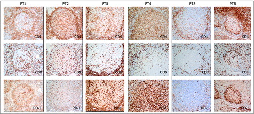 Figure 5. Localization of PD-1+T cells in the lymph nodes of these 6 subjects. Immunohistochemical staining for CD4, CD8, and PD-1 (dark brown) was done on formalin-fixed, paraffin-embedded lymph nodes of 6 FL patients before treatment. Original magnification, ×200 for IHC pictures.