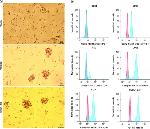 Figure 2. Characters of ROBO1-NK cells. (A) Morphology comparison of PBMCs (upper panel), PBMC-NK cells (mid panel) and ROBO1-NK cells (bottom panel) under bright field. (B) Biomarkers determination of ROBO1-NK cells by flow cytometry. For the biomarkers CD34, CD45, CD3, CD56 and CD16, negative controls were used irrelevant IgG replacing primary antibody for incubating, presented as red peaks. For the ROBO1-CAR detection, negative control was used PBMC-NK incubating with anti-CAR antibody, presented as red peak. Samples in detection were presented as blue peaks.