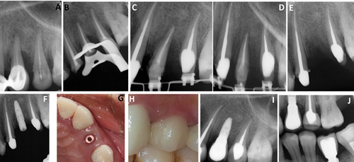 Figure 5 Preoperative view with vertical bone defect around tooth #24 (A), during RCT (B), orthodontic extrusion (C and D), extraction and implant of tooth #24 (E and F), postoperative view of dental implant (G), cemented crown (H), periapical X-ray (I), and 6 months postoperative (J).
