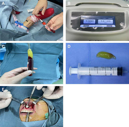 Figure 2 Produced PRF. (A) Take foot venous blood. (B) Put the test tube into refrigerated centrifugal machine at 1400 for 15 min. (C) Prepared clot. (D) Prepared PRF. (E) Put 2 units of BIO-GENE artificial bone meal and PRF into the operative area.