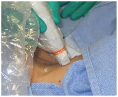 Figure 4 Ultrasound probe prepared within sterile sheath.