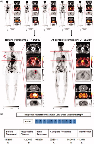 Figure 1. Results of diagnostic imaging throughout the disease course. (A) Whole body metabolic F-18 fluorodeoxyglucose (FDG) PET (maximum intensity projection, left) and axial CT, PET-CT, and PET (right, from top to bottom) of a cervical and an abdominal cross-section imaging are shown, corresponding to the timeline showing therapy and disease status. Red circles of the whole body PET indicate the bone metastasis of the right humerus and red circles of the PET on the cervical cross-section show the metabolic activity of the left lymphadenopathy which is also marked by white and green arrows of the CT and PET-CT. The abdominal cross-section shows the abdominal tumor mass with high metabolic activity. Panel A (left) represents the status two months before start of treatment with regional hyperthermia and low-dose chemotherapy. Of note is the high metabolic activity of multiple bone lesions (e.g., scapula, vertebral column, right humerus, pelvis, sternum, and os sacrum). Panel B shows images 1 month after DLI, when the response to DLI had not occurred, with apparent continued worsening disease at all three sites, showing progression of the abdominal tumor, the appearance of a new bone lesion at the right extremity, and the increased size of the lymphadenopathy with increased metabolic activity before entering treatment. Panel C shows images 12 weeks after two treatment cycles. The heat-targeted abdominal tumor mass showed a partial response with lower metabolic activity. Furthermore, disease response outside of the hyperthermia field was seen with only minor remaining activity detectable at the right humerus (red circle) and at the involved left lymph node (CT, white arrow and PET-CT, green arrow). Panel D shows images after nine treatment cycles with complete response of the abdominal tumor and of distant metastases. Rest of focal activity corresponds to an implanted stent. Panel E illustrates 2 months after end of the 11th cycle the recurrence of local and distant disease at multiple sites. Enlargements are shown for Panel B (12/2010) at recurrent progressive disease and D (08/2011) at complete remission after regional hyperthermia plus low-dose chemotherapy. (B) Schematic drawing of the treatment course: The numbers (blue) indicate the number of each cycle of low-dose chemotherapy combined with regional hyperthermia. The date of imaging and disease status is given by the letters A, B, C, D, and E.