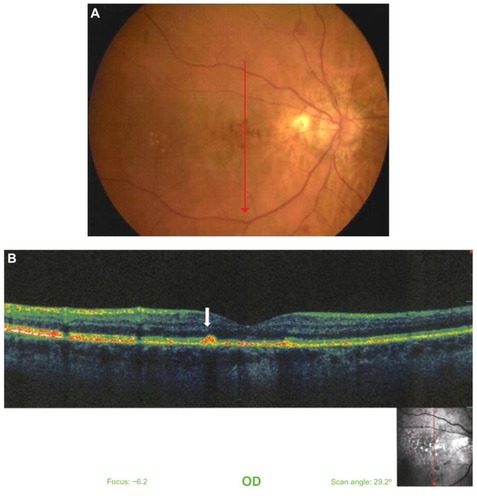 Figure 1 Color fundus photograph of the right eye in a patient aged 38 years with β-thalassemia. (A) Fluorescein angiography of the same eye. Hyperpigmented and hypopigmented lesions in the macula are evident. Notice also the presence of angioid streaks. (B) Vertical optical coherence tomography scan through the fovea.