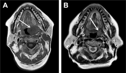 Figure 2 Oropharyngeal magnetic resonance images obtained before (A) and after (B) treatment. The images depict a complete regression of the left tonsillar mass after 1 month of chemotherapy (arrows).