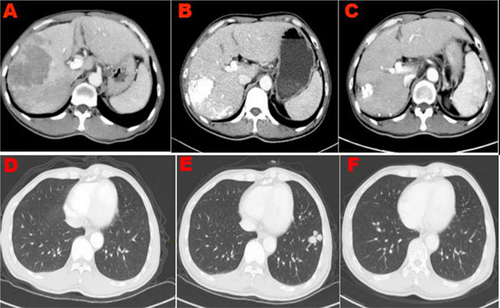 Figure 2 (A) Case 1, a 65-year-old male patient with massive liver cancer in the right lobe of the liver complicated with portal vein tumor thrombus was given (A and D), transarterial chemoembolization and sorafenib treatment. The intrahepatic lesions were well controlled (B), and left lung metastasis occurred (E). CT imaging from case 1 at 9 weeks after initiation of rego-PD-1 treatment showed that all metastases in the left lung disappeared (F); Intrahepatic lesions were not enhanced (C).