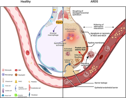 Figure 1 The pathological physiology of acute respiratory distress syndrome. The inflammation-induced damage results in destruction of the alveolar-capillary walls, aggregation of proinflammatory cells, formation of hyaline membranes, and an abundance of protein-rich edema in the interstitium and alveoli. The unregulated and excessive immune reaction that contributes to alveolar injury, then, directly increases the permeability of the alveolar-capillary barrier, and the apoptosis of alveolar epithelial cells type II (AEC II) weakens the secretion of pulmonary surfactant and the clearance of alveolar fluid and exacerbates alveolar stroma and protein-rich edema within the alveoli. (Created using BioRender.com).