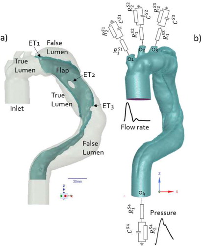 Figure 1. (a) Patient specific geometry at T0. (b) Fluid boundaries conditions and mesh.