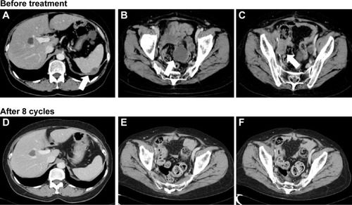 Figure 1 Multiple intraperitoneal dissemination (A and B) and intrapelvic lymph node metastases (C) were observed before treatment (arrows). After eight cycles of weekly paclitaxel plus bevacizumab therapy, the antitumor effect was evaluated as a complete response (D–F).
