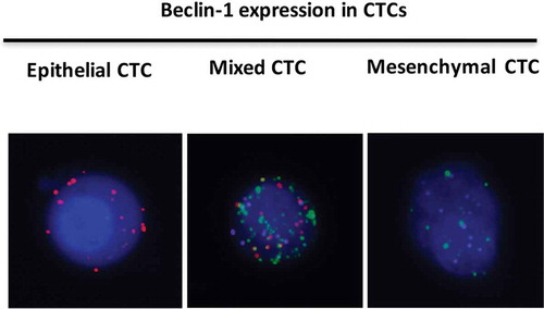 Figure 5. Beclin-1 expression in CTCs. Epithelial markers were labeled with Alexa Fluor 594 (Red color); mesenchymal markers were labeled with Alexa Fluor 488 (Green color); Beclin-1 marker was labeled by Alexa Fluor 647 (Purple color). Right panel showed the distribution of three CTCs types in kidney cancers.