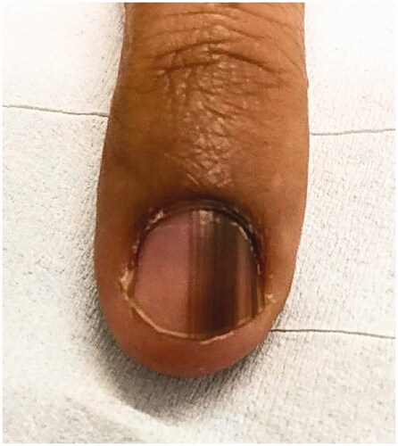 Figure 7. Subungual melanoma, 6 mm brown band. (DOI: 10.1016/j.jaad.2018.08.033, Permission for reuse of this image has been obtained from the copyright holder (Elsevier) and applies to publications with the Creative Commons license).
