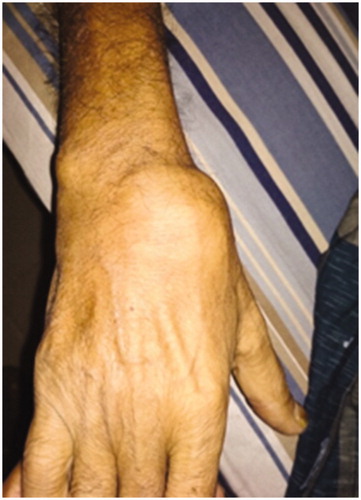 Figure 4. Soft tissue swelling over the wrist due to amyloid deposit.