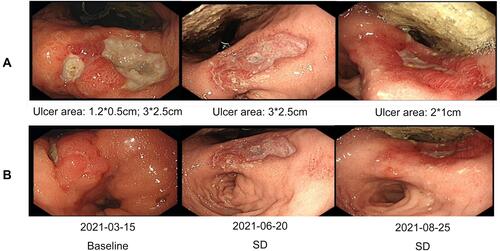 Figure 4 The changes in the lesions observed during endoscopy. (A) The changes in the gastric ulcer lesions observed during three independent endoscopies. (B) The changes observed in the gastric antrum wall during three independent endoscopies.