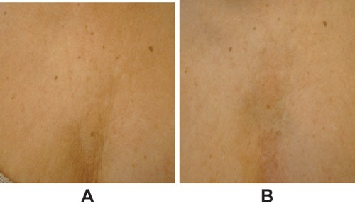 Figure 2 Representative images of décolletage (A) before treatment and (B) 1 month after 1.5-mL injection of VYC-12L. Images courtesy of Patricia Ogilvie, MD.