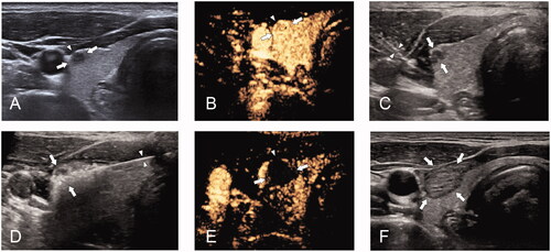 Figure 1. (A) 42-year-old woman with papillary thyroid cancer with capsular invasion (CI) was treated with microwave ablation (MWA). (A) pre-MWA, ultrasound(US) showed a hypoechoic target tumor (arrows) with CI (triangles); (B) before MWA, contrast-enhanced US (CEUS) showed a hypo-enhancement pattern in the artery phase (arrows); (C) the hydrodissection technique (triangles) was used to protect the surrounding structures (arrows); (D) US showed a hyperechoic pattern in the tumor (arrows) during ablation; (E) post-MWA, CEUS showed no enhancement (arrows) in the tumor area; and (F) on one-month post-MWA, US showed a hypoechoic ablation zone (arrows).