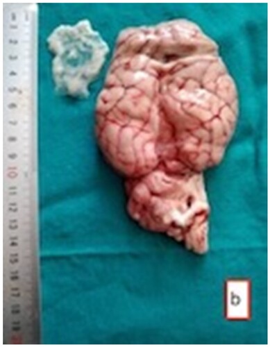 Figure 4. The cyst (arrow) in the frontal region of the brain with evacuated fluid and white scolexes.