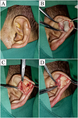Figure 1 Pseudocyst is located in the scaphoid fossa of the left ear (A). An incision is made at the fold near the external helix and separated to make it slightly larger than the cyst margin (B). The anterior wall cartilage is incised near the incision and cyst fluid is released (C). The anterior wall cartilage is completely removed and the bleeding of the anterior wall skin and incision is stopped (D).