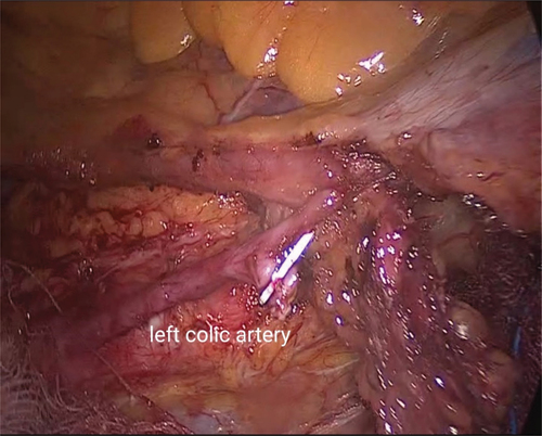 Figure 1. Clipping descending branch of inferior mesenteric artery with left colic artery sparing.