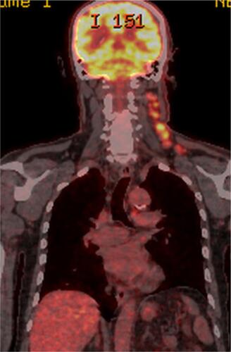 Figure 2 Fused positron emission tomography-fluorodeoxyglucose (PET-FDG) image before AVD treatment.