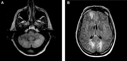 FIGURE 2  Repeat MR imaging (FLAIR sequence) demonstrating more extensive involvement of the cerebellum (A) and oedema in the subcortex of the frontal and occipital lobes (B) consistent with PRES.