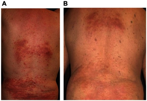 Figure 2 Clinical improvement of nummular atopic dermatitis with adjuvant ZnO textile overnight (A) before and (B) after 4 days.