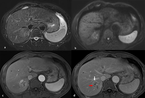 Figure 5 A 64-year-old male patient with hepatitis B–related liver cirrhosis and cHCC-CCA is categorized as Liver Imaging Reporting and Data System category LR-M. A 3.5 cm tumor in the right lobe of the liver shows heterogeneous hyperintensity on T2-weighted imaging (a) and diffusion weighted imaging (b). (c) The arterial phase shows peripheral enhancement on contrast-enhanced T1-weighted imaging with the contrast agent Gd-DTPA, and the nodule exhibits peripheral washout (red arrow) and an enhancing capsule (white arrow) in the delayed phase (d). Small recurrent lesions were found 5 months after surgery in this patient.