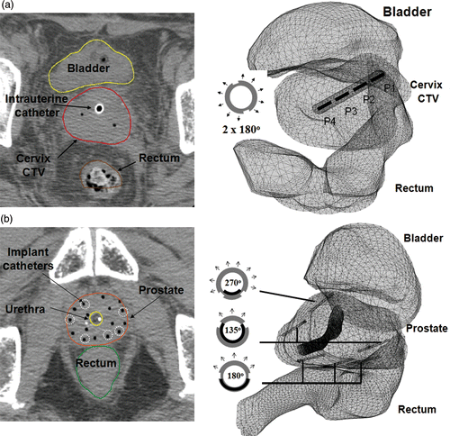 Figure 2. Examples of geometry planning and anatomy-based 3D thermal modeling of catheter-based ultrasound hyperthermia treatment using (a) an intrauterine applicator for cervix and (b) multiple interstitial applicators for prostate. CT scans (slice thickness 2.5 or 3 mm) were overlaid by segmented contours of rectum, bladder and target.