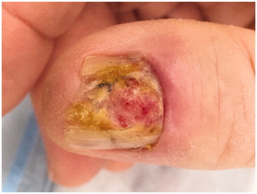Figure 1. Lesion on the right thumb shown in December of 2016 prior to surgical treatment.
