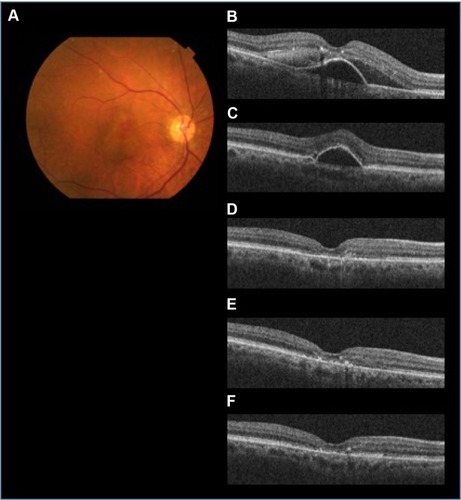 Figure 2 The efficacy of aflibercept for AMD refractory to ranibizumab (patient 8 with PCV).