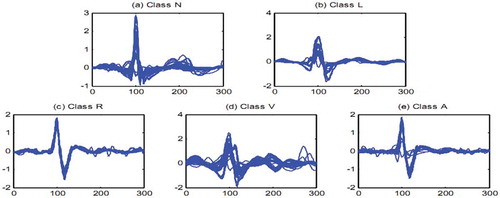 Figure 1. Fifty randomly selected heartbeat signals for (a) Class N, (b) Class L, (c) Class R, (d) Class V, (e) Class A.