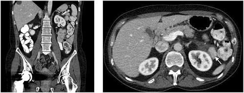 Figure 1. CT scan reveals a lobulated, contrast capturing mass, approximately 2.6 cm, as indicated by the arrow.
