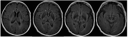 Figure 1 Brain MRI showed multiple ischemic foci in the brain.