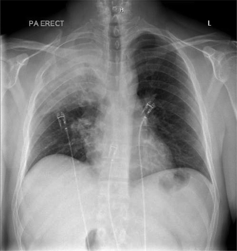 Figure 1. Chest X-ray showing dense consolidation of the right upper lobe