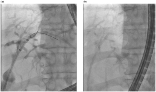 Figure 3. The fluoroscopy views of patient (number 2) with left site intrahepatic stricture (a) before and (b) after stenting with Archimedes stent.
