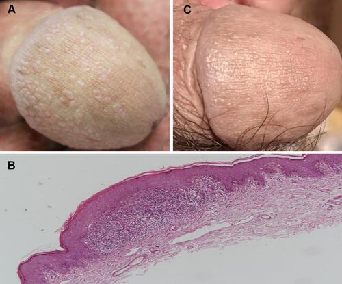 Figure 1 Small glistening and skin-colored papules on the penis (A). Skin biopsy from lesion showed the characteristic feature of ball and claw configuration of the epidermis, inflammatory infiltrate is composed of lymphocytes. Hematoxylin-eosin stain, 40× (B). Most of these papules subsided after 1 year (C).